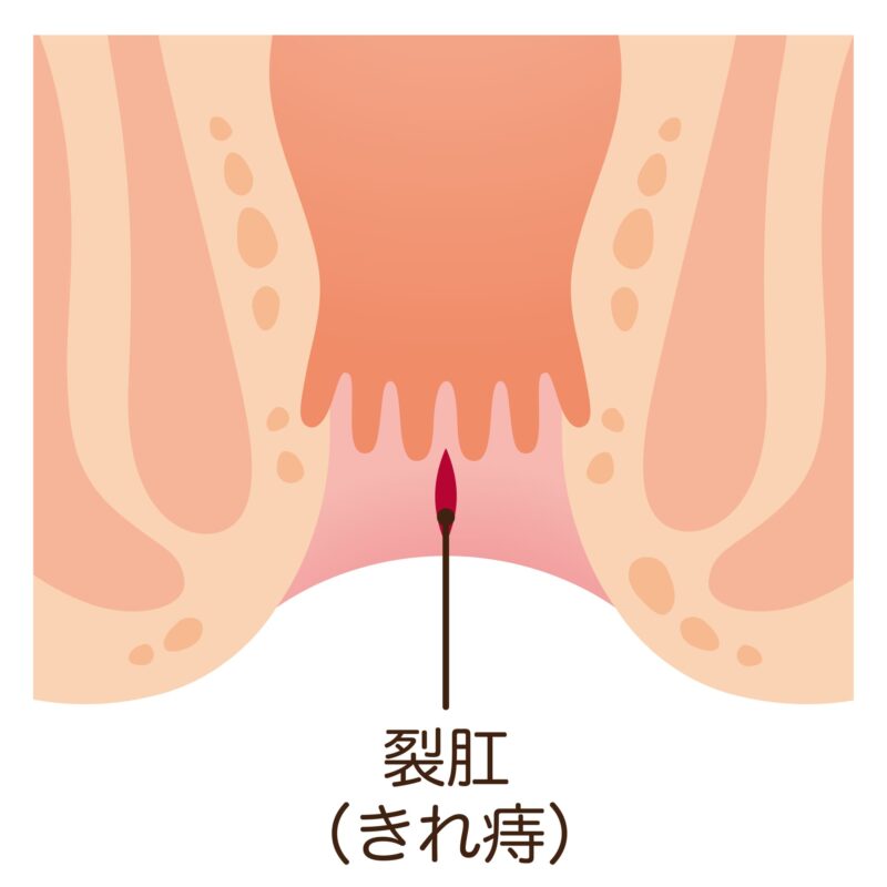 切れ痔（裂孔）